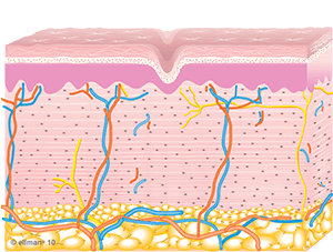 Skin Tightening Graphic of Collagen Remodeling
