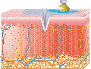 Skin Tightening Graphic of Collagen Synthesis Begins