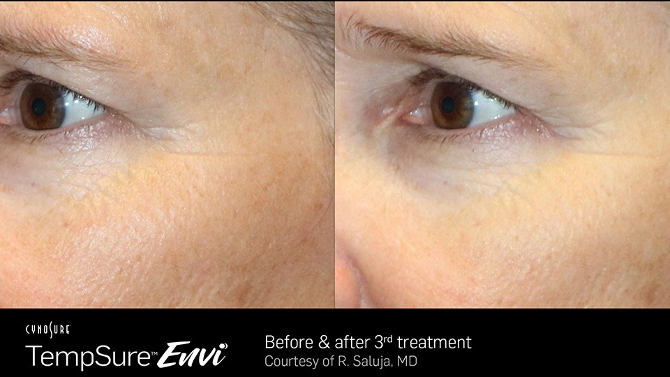 TempSure Envi Skin Tightening Before and After