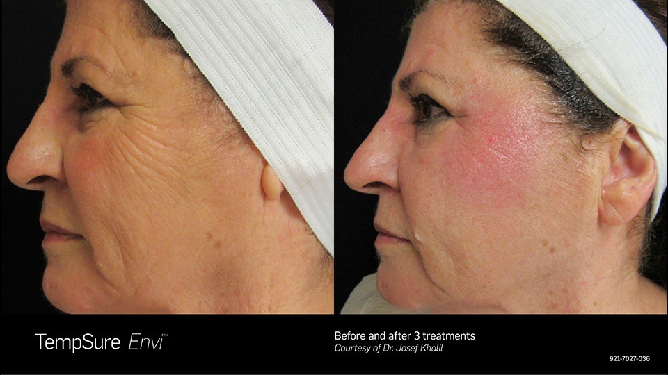 Non Surgical Skin Tightening Before and After
