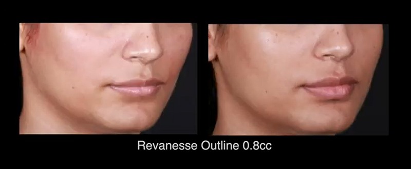 Revanesse Outline Before and After
