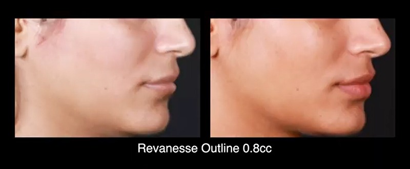 Revanesse Outline Before and After