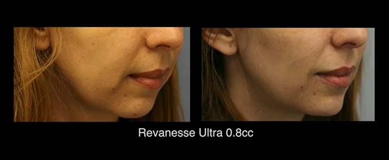 Revanesse Ultra Before and After