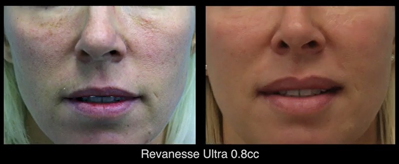 Revanesse Ultra Before and After